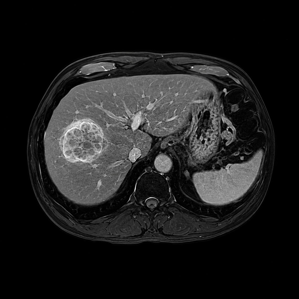 Contrast abdominal MRI